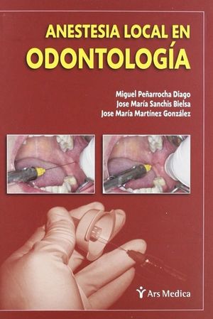 ANESTESIA LOCAL EN ODONTOLOGIA / PD.