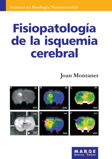 Fisiopatología De La Isquemia Cerebral