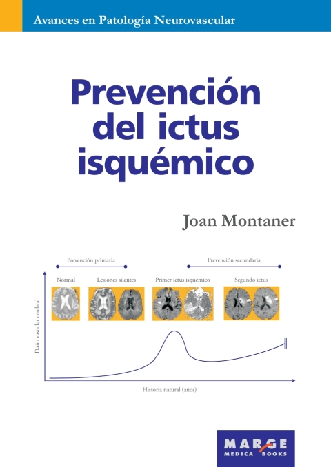 Prevención Del Ictus Isquémico